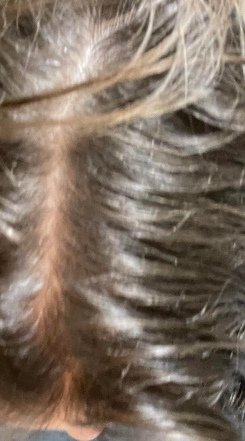 Stunning Oily Scalp Remedies Artwork Art Stunning Oily Scalp Remedies Artwork Art