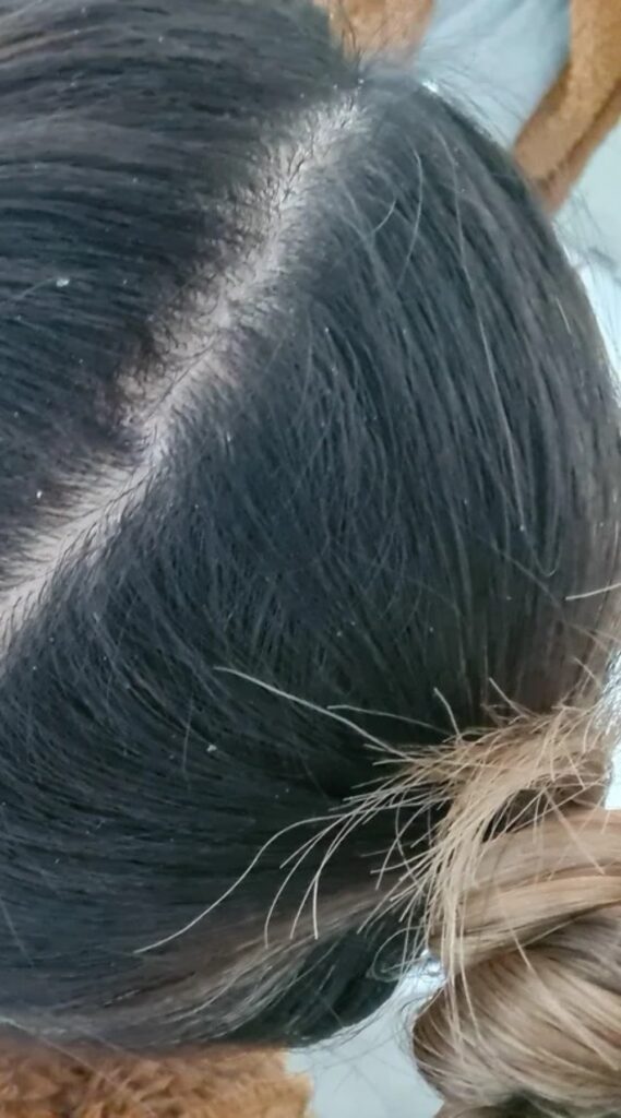 Itchy Scalp After Hair Coloring: Causes and Soothing Remedies ...